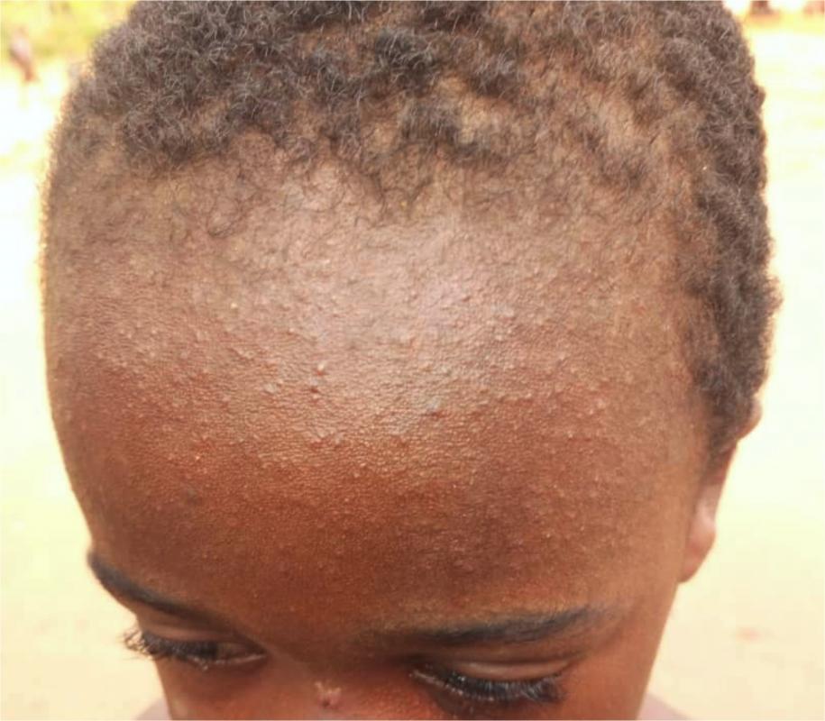 A little boy suffering from Measles