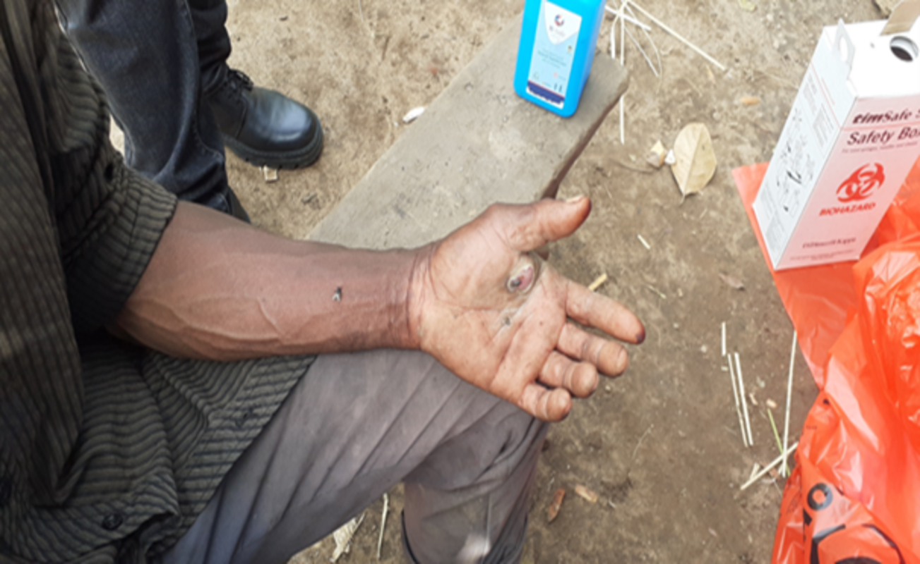 A suspected Anthrax patient