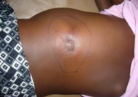 Buruli Ulcer Article_Chineye's Leg