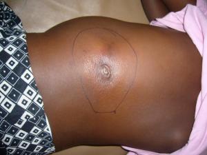 Buruli Ulcer Article_Chineye's Leg